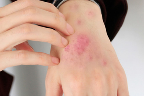 红疮狼斑早期图片 红斑狼疮7大症状解读