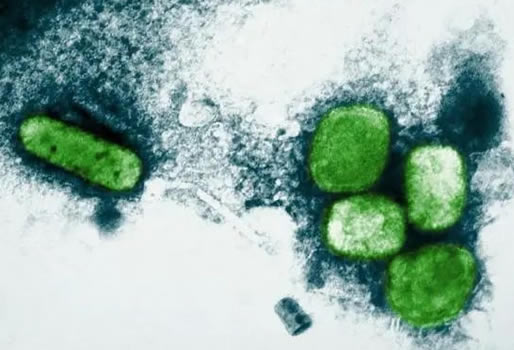 天花是啥病 天花病是什么病呢 天花是啥病 天花病是什么病呢