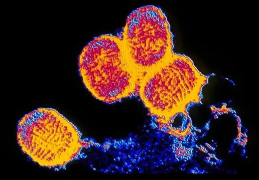 天花是啥病 天花病是什么病呢 天花是啥病 天花病是什么病呢