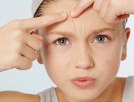 长痘痘可以去角质吗