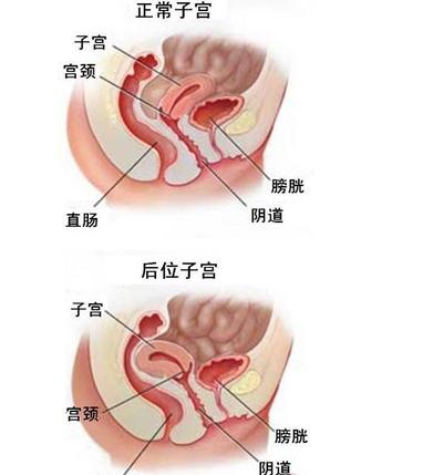子宫后位是什么意思