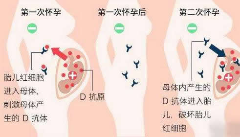 rh阴性血能生二胎吗