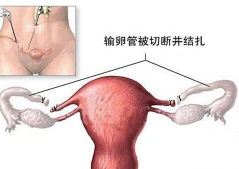 结扎对男性的影响