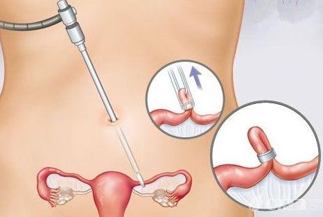 结扎对男性的影响