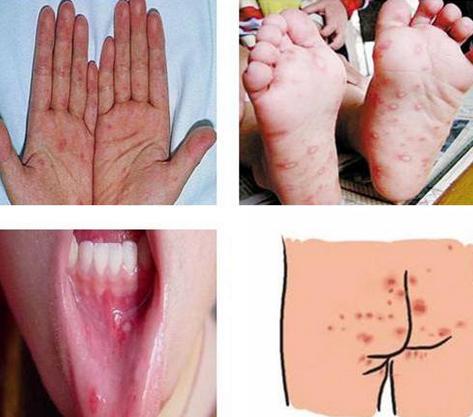 手足口病初期症状