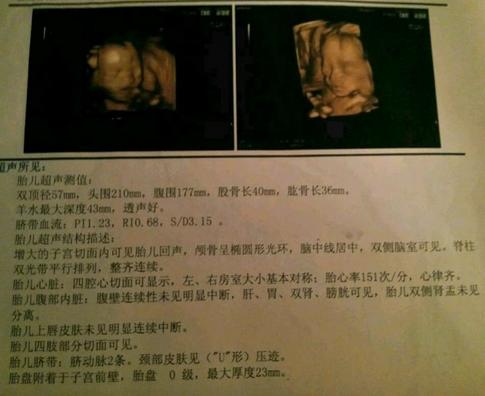 从彩超看生男生女 从彩超看生男生女