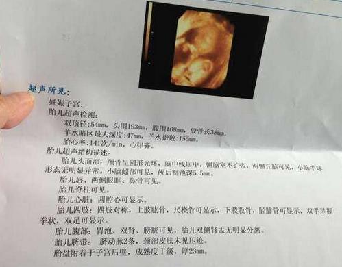 四维彩超看胎儿性别