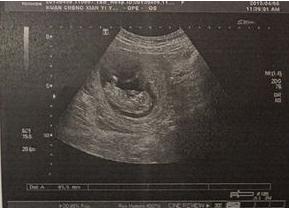 b超如何看胎儿性别