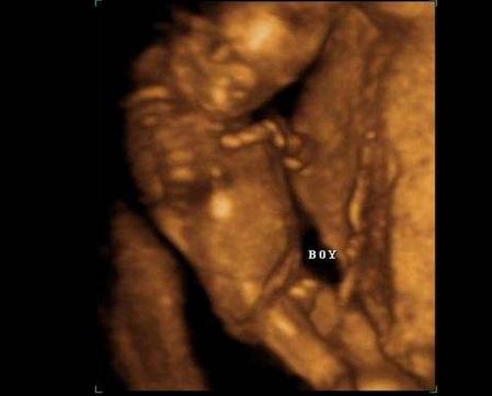b超如何看胎儿性别