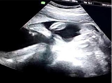 胎儿四维彩超图性别四维彩超看胎儿性别对比图