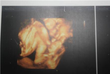 胎儿四维彩超图性别 胎儿四维彩超图性别