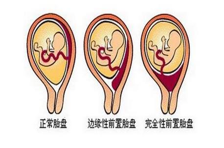 前壁胎盘胎盘前壁好还是后壁好只要不是前置就好