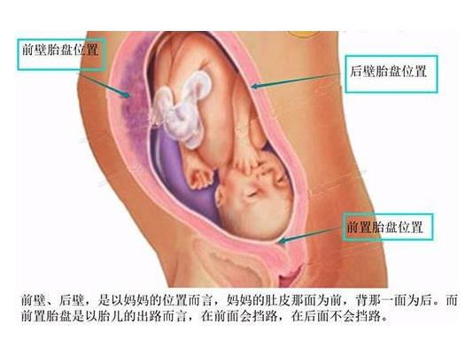 【前壁胎盘】胎盘前壁好还是后壁好 只要不是前置就好 【前壁胎盘】胎盘前壁好还是后壁好 只要不是前置就好