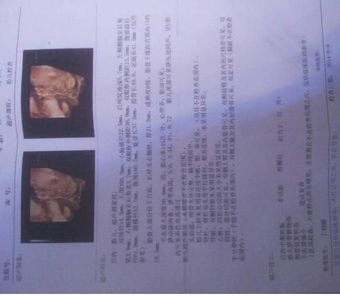 四维彩超如何看性别