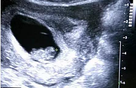 如何分辨胎儿男女民间9种说法 如何分辨胎儿男女民间9种说法