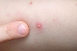 01儿童水痘初期症状图片