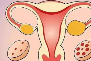 女孩十七岁幼稚子宫大概多久能治好 女孩十七岁幼稚子宫大概多久能治好