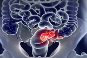 注意4个最为明显的肠癌信号(大便性状改变) 注意4个最为明显的肠癌信号(大便性状改变)