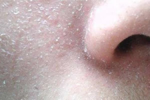 洗完脸脸上起皮和白色碎屑怎么办