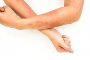 女性长湿疹引起的原因(湿疹初期图片) 女性长湿疹引起的原因(湿疹初期图片)