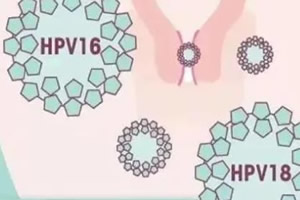 女性hpv最明显的征兆 感染HPV的3种症状 女性hpv最明显的征兆 感染HPV的3种症状