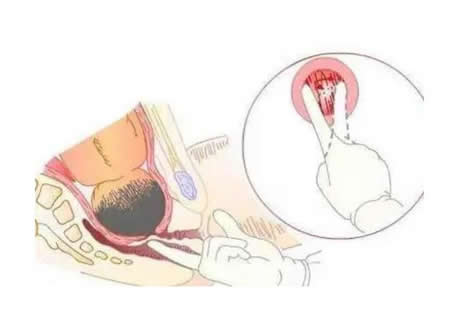 宫口1到10指疼痛程度 开10指相当于三叉神经痛(10级痛对照表)