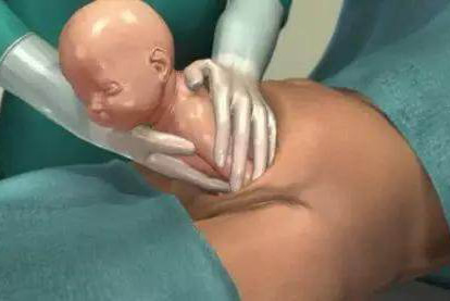 剖腹产住院需要多少钱？用生育险报销多少