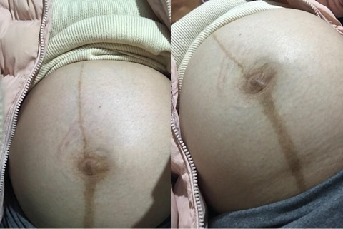 妊娠线上细下粗是男孩？妊娠线看男女方法