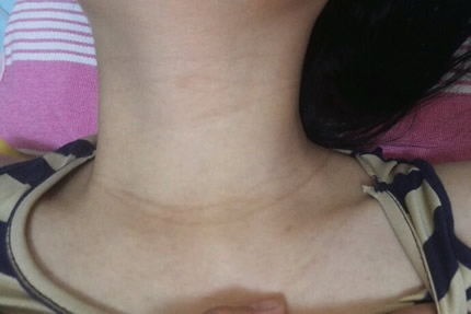 怀孕脖子长妊娠纹图片及原因
