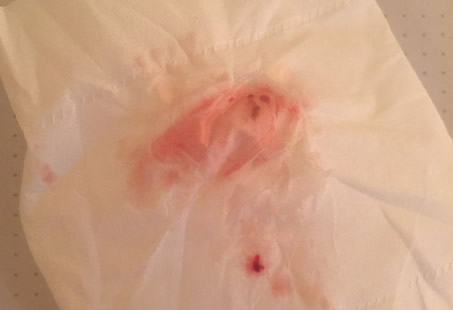 怀孕典型的着床出血图片的样子