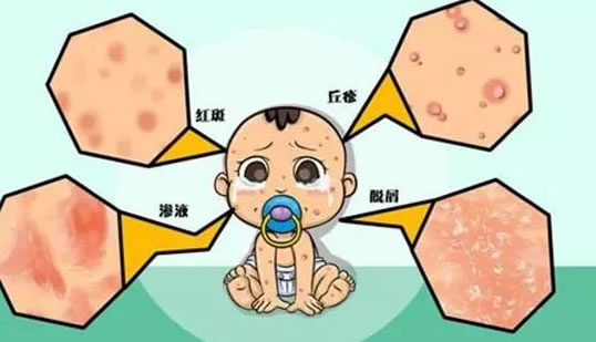 婴儿湿疹病因症状预防护理