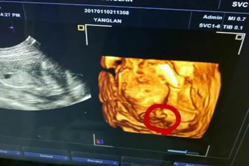 nt值小于1.5就一定是女孩吗 nt值1.2mm是男还是女